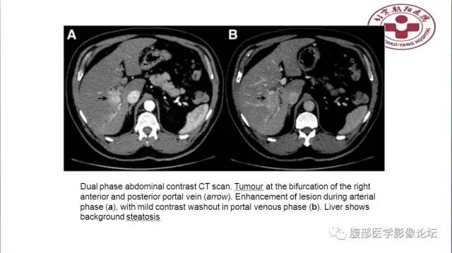 【病例】肝左外叶腺神经内分泌癌1例CT
