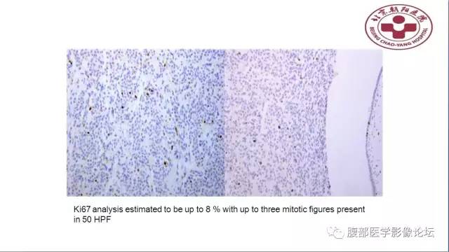 【病例】肝左外叶腺神经内分泌癌1例CT