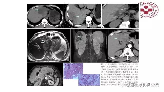 【病例】肝左外叶腺神经内分泌癌1例CT