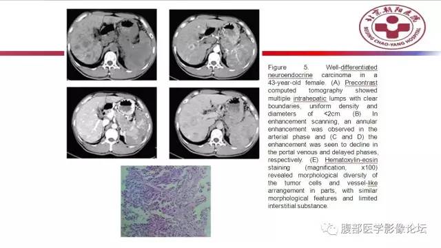 【病例】肝左外叶腺神经内分泌癌1例CT
