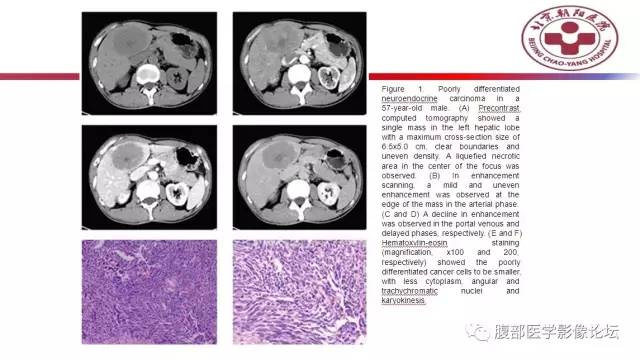 【病例】肝左外叶腺神经内分泌癌1例CT