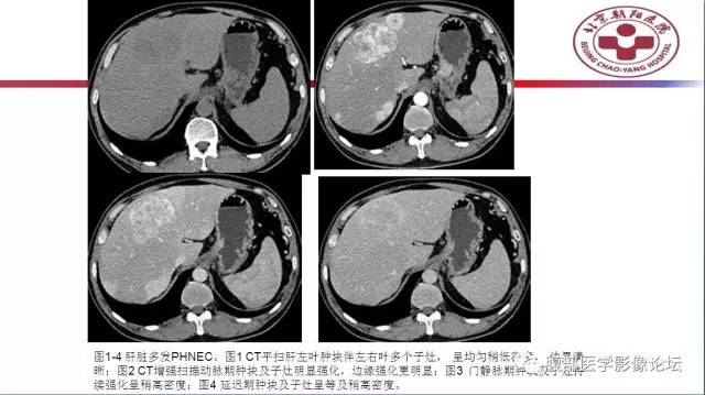 【病例】肝左外叶腺神经内分泌癌1例CT