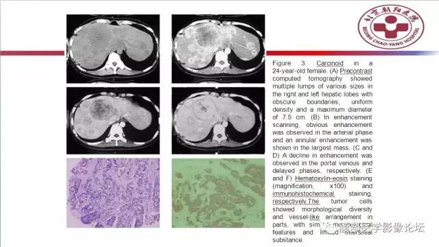 【病例】肝左外叶腺神经内分泌癌1例CT