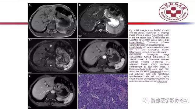 【病例】肝左外叶腺神经内分泌癌1例CT