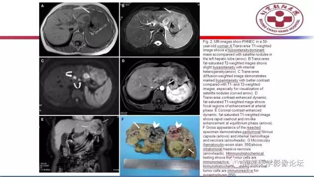 【病例】肝左外叶腺神经内分泌癌1例CT