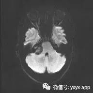【病例】听神经瘤1例MR影像表现