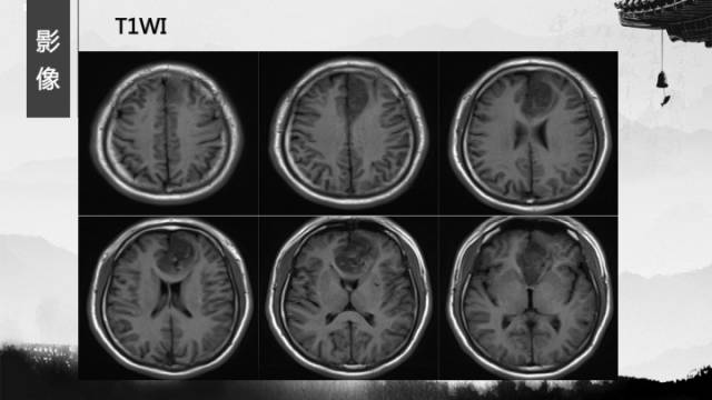 【病例】少突胶质细胞瘤1例CT及MR影像表现