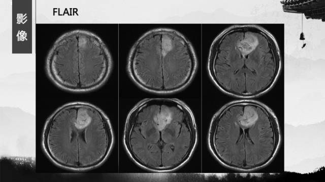 【病例】少突胶质细胞瘤1例CT及MR影像表现