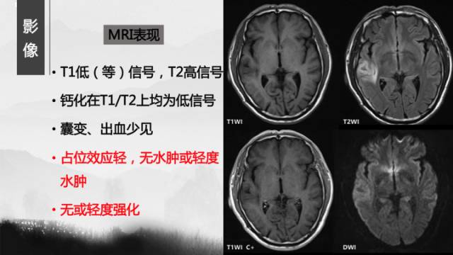 【病例】少突胶质细胞瘤1例CT及MR影像表现