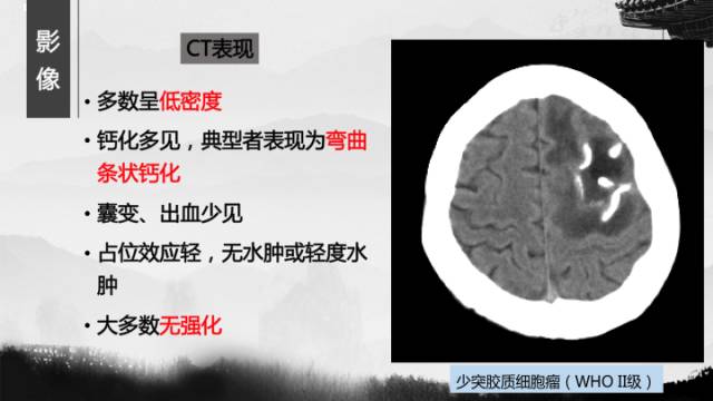 【病例】少突胶质细胞瘤1例CT及MR影像表现