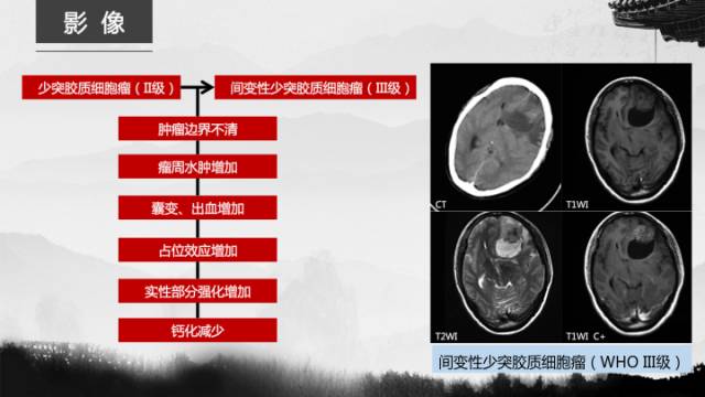 【病例】少突胶质细胞瘤1例CT及MR影像表现