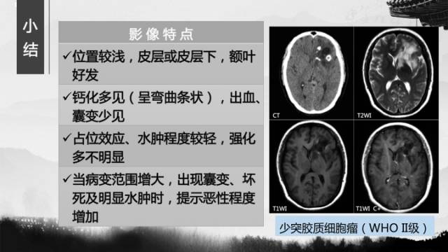 【病例】少突胶质细胞瘤1例CT及MR影像表现