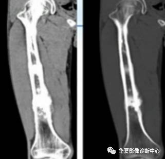 10个典型病例，让你学会骨肿瘤的诊断思路