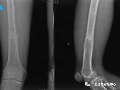 10个典型病例，让你学会骨肿瘤的诊断思路