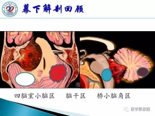 【PPT】儿童幕下脑肿瘤的诊断思路和功能MRI的规范使用