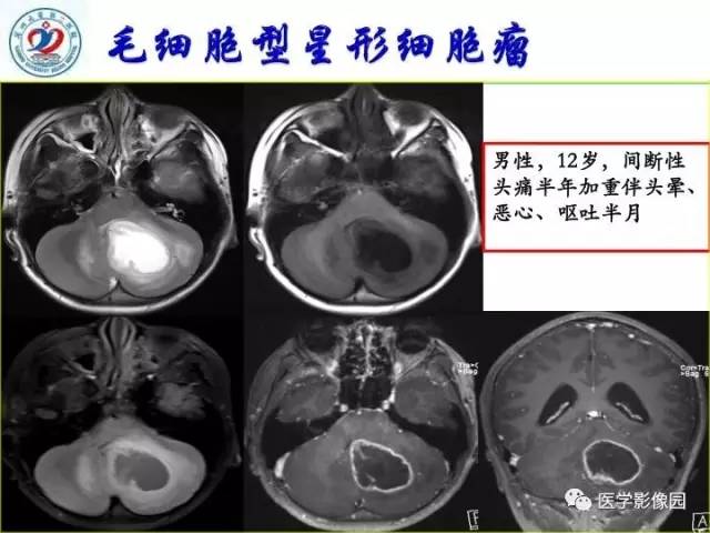 【PPT】儿童幕下脑肿瘤的诊断思路和功能MRI的规范使用