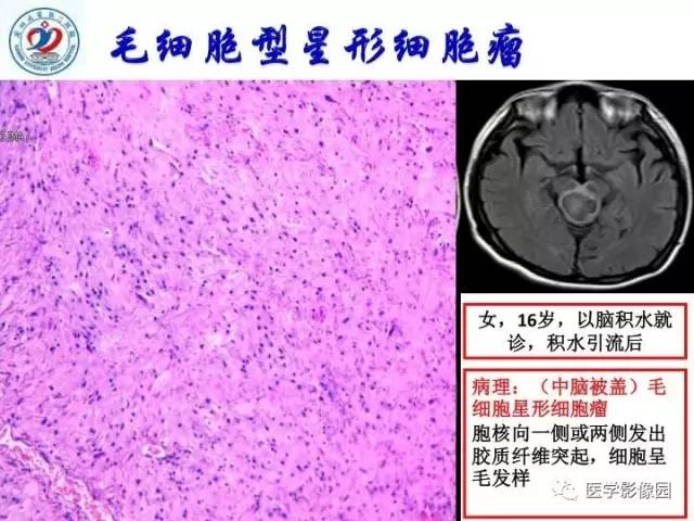 【PPT】儿童幕下脑肿瘤的诊断思路和功能MRI的规范使用