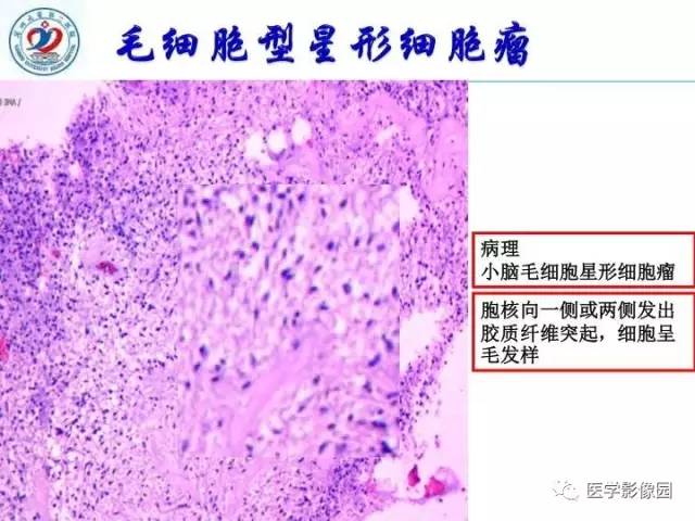 【PPT】儿童幕下脑肿瘤的诊断思路和功能MRI的规范使用