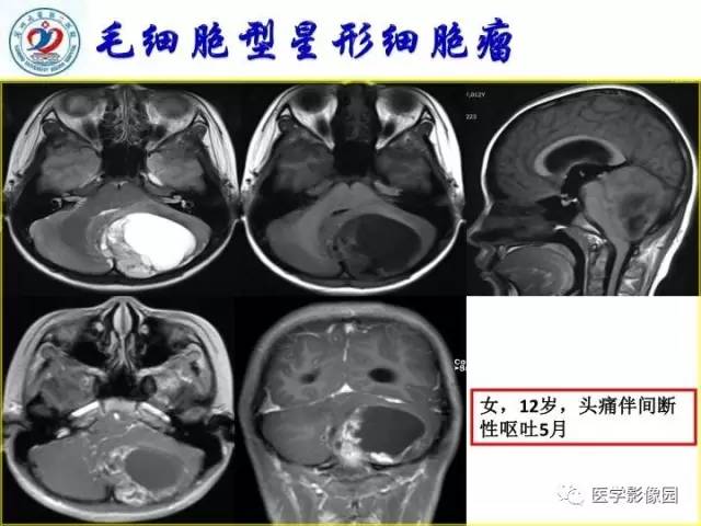 【PPT】儿童幕下脑肿瘤的诊断思路和功能MRI的规范使用