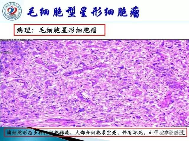 【PPT】儿童幕下脑肿瘤的诊断思路和功能MRI的规范使用