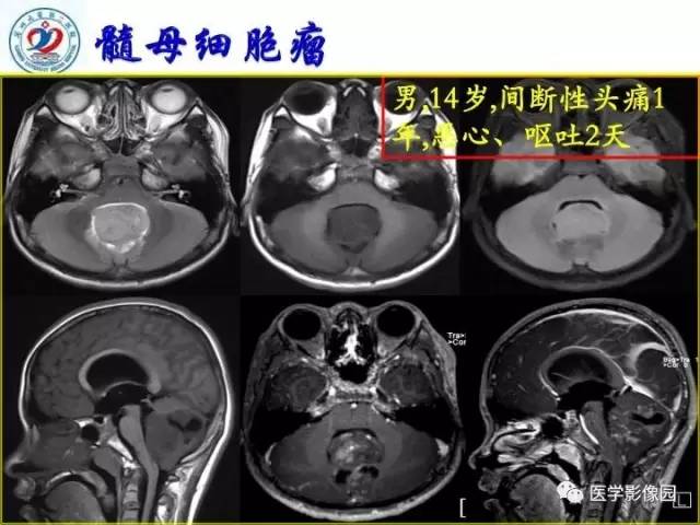 【PPT】儿童幕下脑肿瘤的诊断思路和功能MRI的规范使用