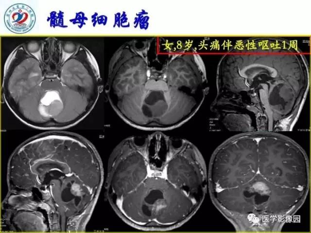 【PPT】儿童幕下脑肿瘤的诊断思路和功能MRI的规范使用