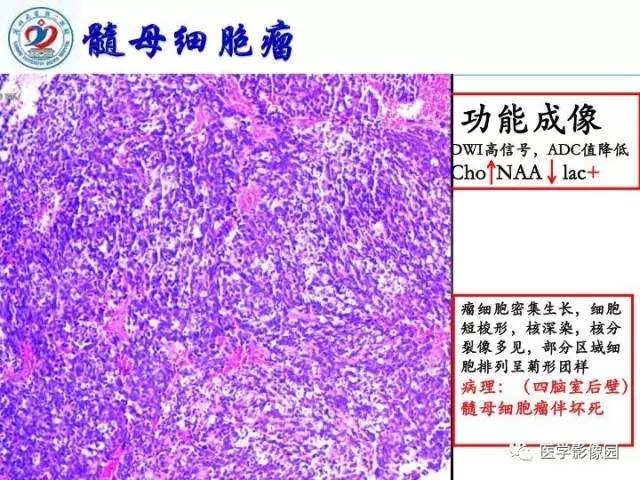 【PPT】儿童幕下脑肿瘤的诊断思路和功能MRI的规范使用