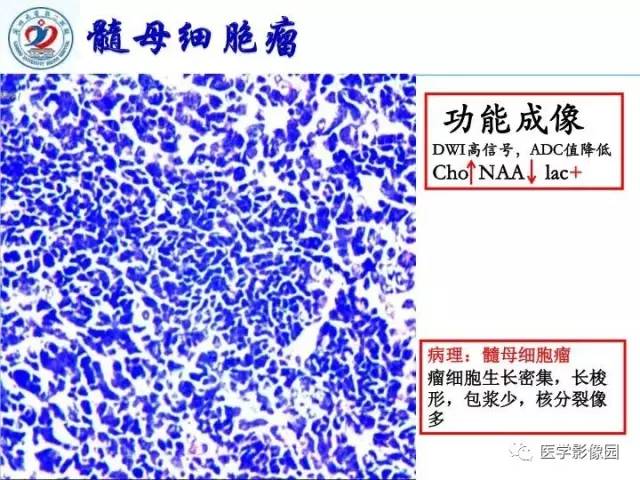 【PPT】儿童幕下脑肿瘤的诊断思路和功能MRI的规范使用