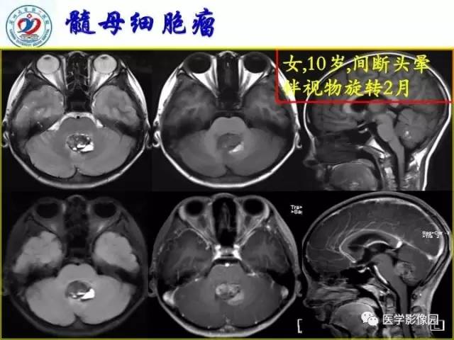 【PPT】儿童幕下脑肿瘤的诊断思路和功能MRI的规范使用