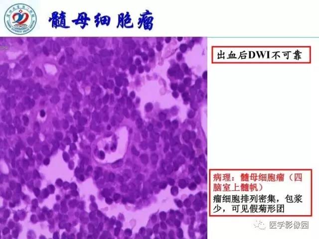 【PPT】儿童幕下脑肿瘤的诊断思路和功能MRI的规范使用