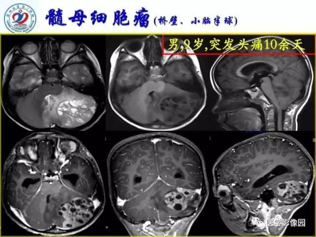 【PPT】儿童幕下脑肿瘤的诊断思路和功能MRI的规范使用