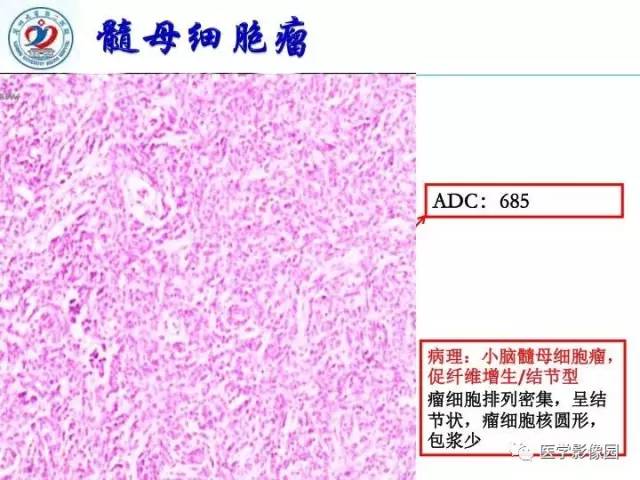 【PPT】儿童幕下脑肿瘤的诊断思路和功能MRI的规范使用