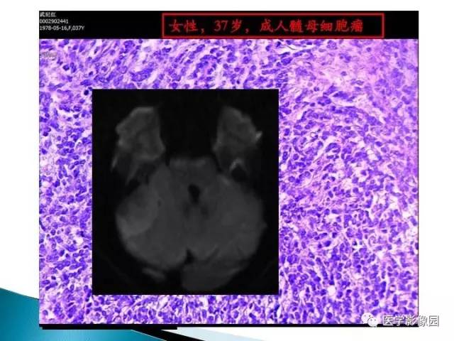 【PPT】儿童幕下脑肿瘤的诊断思路和功能MRI的规范使用