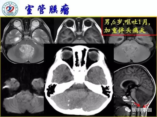 【PPT】儿童幕下脑肿瘤的诊断思路和功能MRI的规范使用