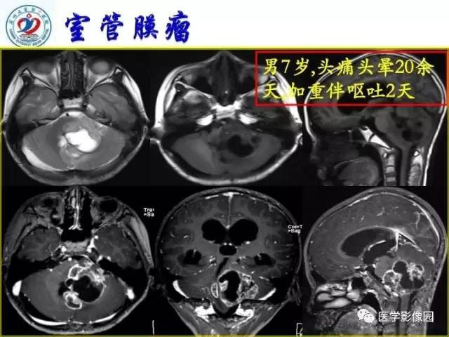 【PPT】儿童幕下脑肿瘤的诊断思路和功能MRI的规范使用