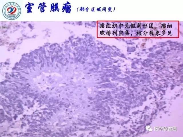 【PPT】儿童幕下脑肿瘤的诊断思路和功能MRI的规范使用