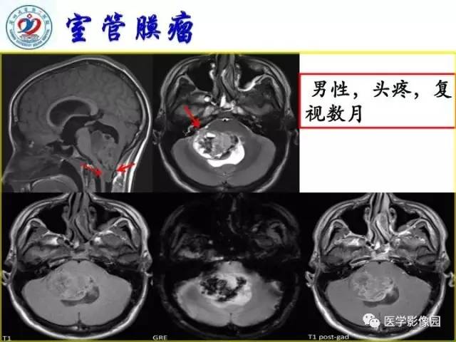【PPT】儿童幕下脑肿瘤的诊断思路和功能MRI的规范使用