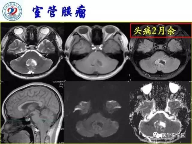 【PPT】儿童幕下脑肿瘤的诊断思路和功能MRI的规范使用