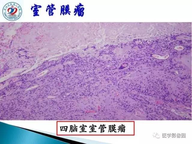 【PPT】儿童幕下脑肿瘤的诊断思路和功能MRI的规范使用