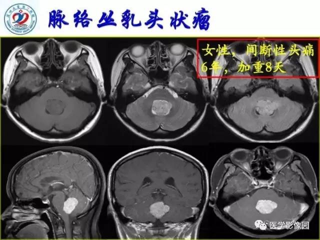【PPT】儿童幕下脑肿瘤的诊断思路和功能MRI的规范使用