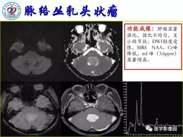 【PPT】儿童幕下脑肿瘤的诊断思路和功能MRI的规范使用