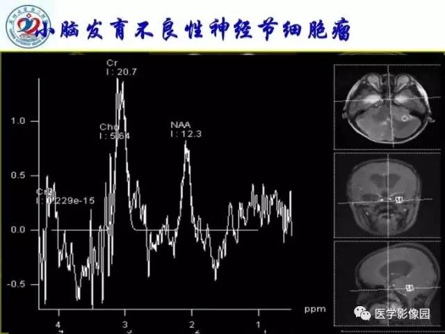 【PPT】儿童幕下脑肿瘤的诊断思路和功能MRI的规范使用