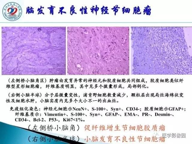 【PPT】儿童幕下脑肿瘤的诊断思路和功能MRI的规范使用