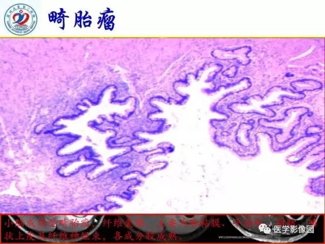 【PPT】儿童幕下脑肿瘤的诊断思路和功能MRI的规范使用