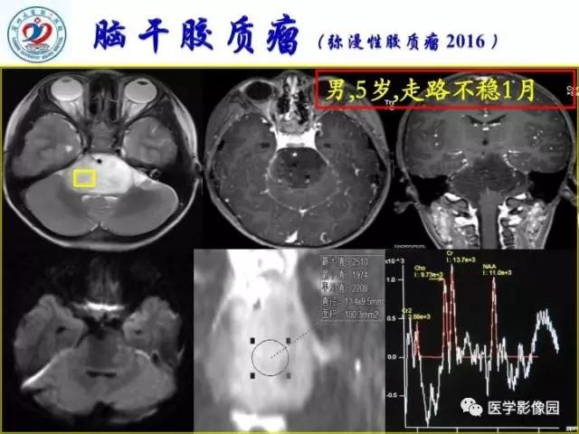 【PPT】儿童幕下脑肿瘤的诊断思路和功能MRI的规范使用