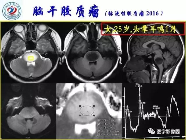 【PPT】儿童幕下脑肿瘤的诊断思路和功能MRI的规范使用