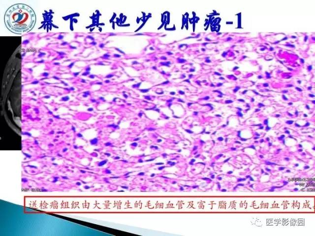 【PPT】儿童幕下脑肿瘤的诊断思路和功能MRI的规范使用