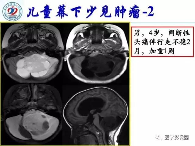【PPT】儿童幕下脑肿瘤的诊断思路和功能MRI的规范使用