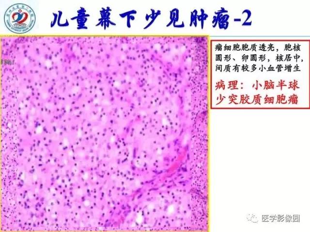 【PPT】儿童幕下脑肿瘤的诊断思路和功能MRI的规范使用