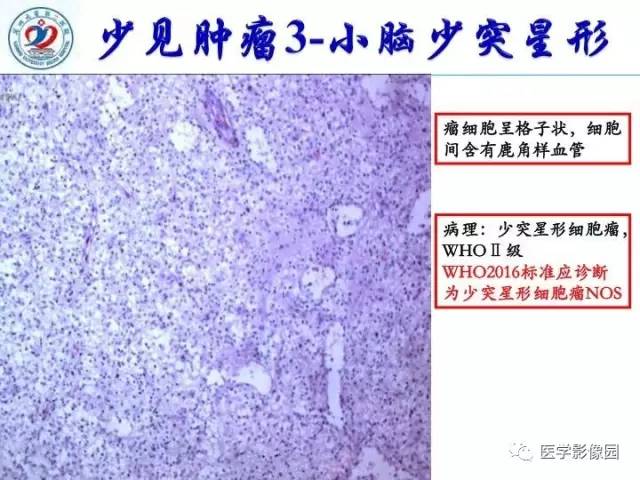 【PPT】儿童幕下脑肿瘤的诊断思路和功能MRI的规范使用